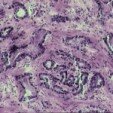 Prostate Cancer